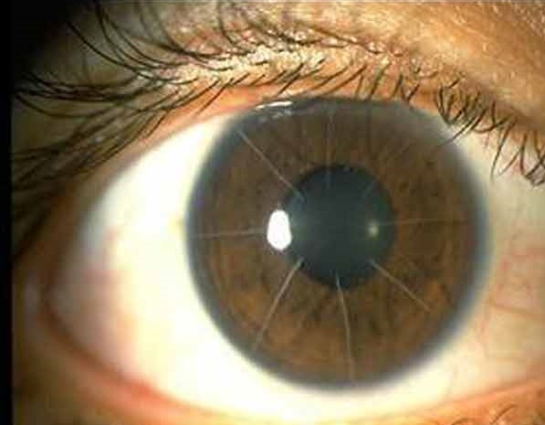 علت جرقه زدن چشم چیست